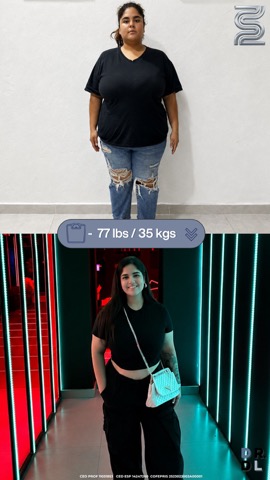 Paciente antes y después, bajó 35 kg