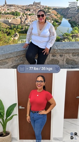 Paciente antes y después, bajó 35 kg