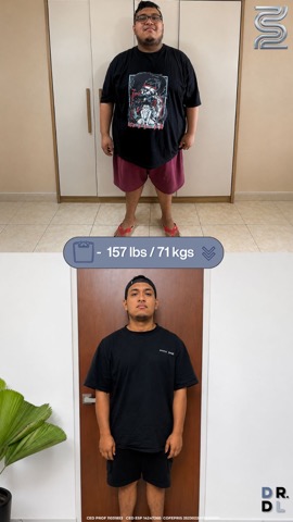 Paciente antes y después, bajó 71 kg