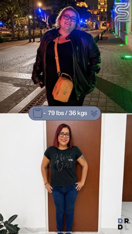 Paciente antes y después, bajó 36 kg