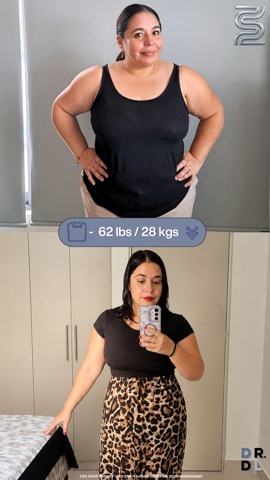 Paciente antes y después, bajó 28 kg