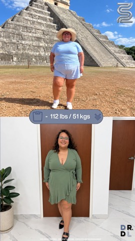 Paciente antes y después, bajó 51 kg