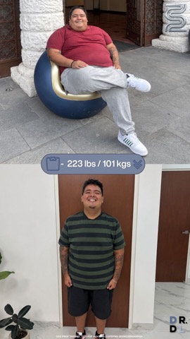 Paciente antes y después, bajó 101 kg