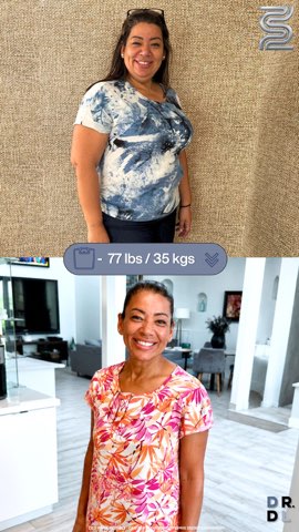 Paciente antes y después, bajó 35 kg