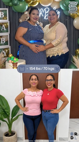 Paciente antes y después, bajó 70 kg