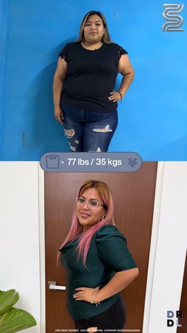 Paciente antes y después, bajó 35 kg