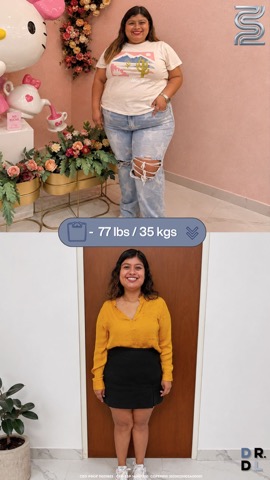 Paciente antes y después, bajó 35 kg