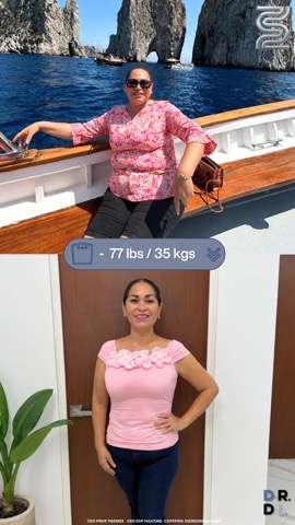 Paciente antes y después, bajó 35 kg