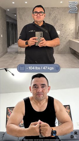 Paciente antes y después, bajó 47 kg