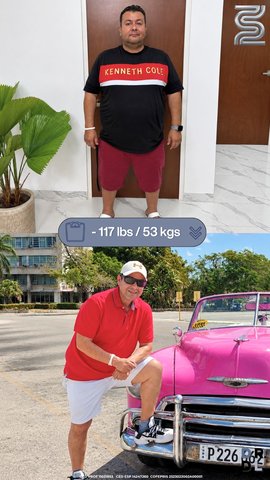 Paciente antes y después, bajó 53 kg