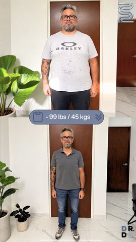 Paciente antes y después, bajó 45 kg