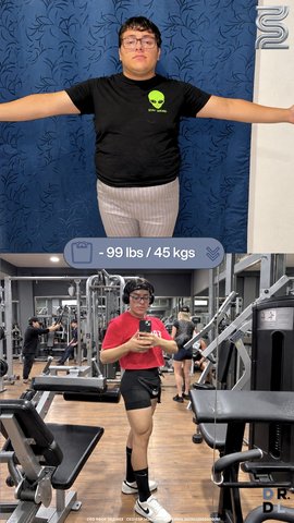 Paciente antes y después, bajó 45 kg