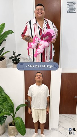Paciente antes y después, bajó 66 kg