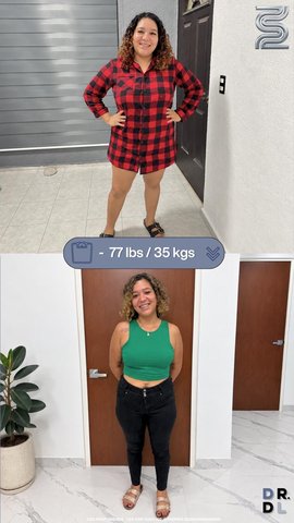 Paciente antes y después, bajó 35 kg