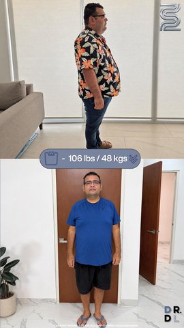 Paciente antes y después, bajó 48 kg
