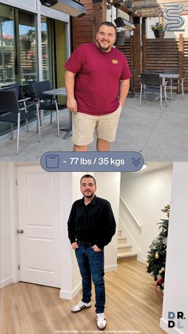 Paciente antes y después, bajó 35 kg