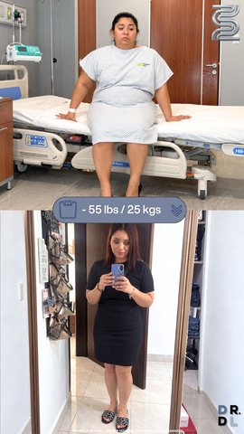 Paciente antes y después, bajó 25 kg