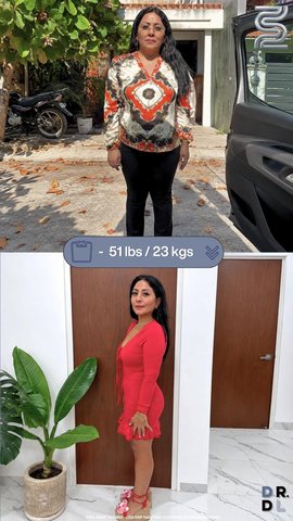 Paciente antes y después, bajó 23 kg