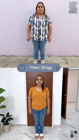 Paciente antes y después, bajó 32 kg
