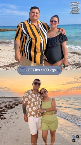 Paciente antes y después, bajó 103 kg