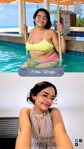 Paciente antes y después, bajó 32 kg