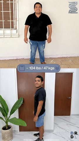 Paciente antes y después, bajó 47 kg