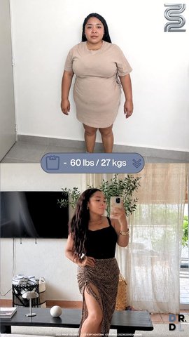 Paciente antes y después, bajó 27 kg