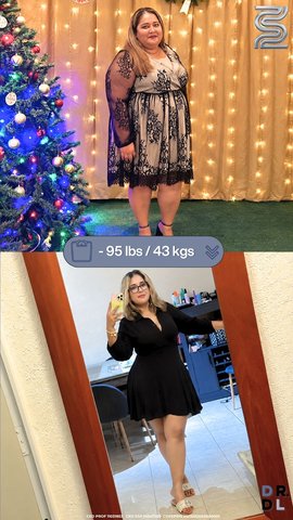 Paciente antes y después, bajó 43 kg
