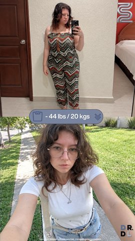 Paciente antes y después, bajó 20 kg