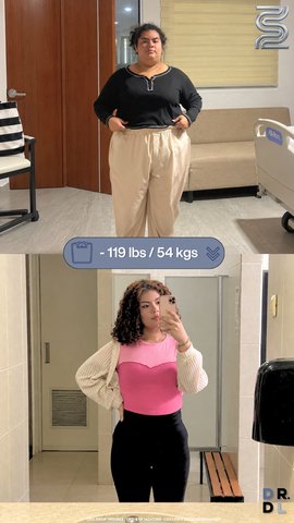 Paciente antes y después, bajó 54 kg