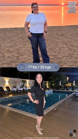 Paciente antes y después, bajó 35 kg