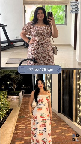 Paciente antes y después, bajó 35 kg