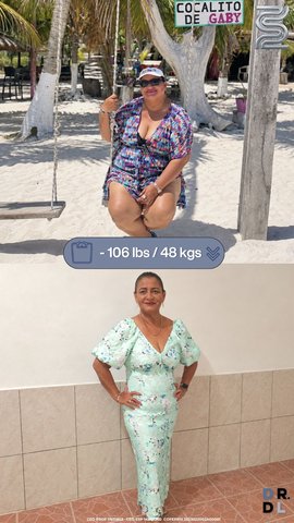 Paciente antes y después, bajó 48 kg